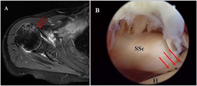 Clinical efficacy and tendon integrity of patients with subscapularis tear by the technique of arthroscopic single external row repair